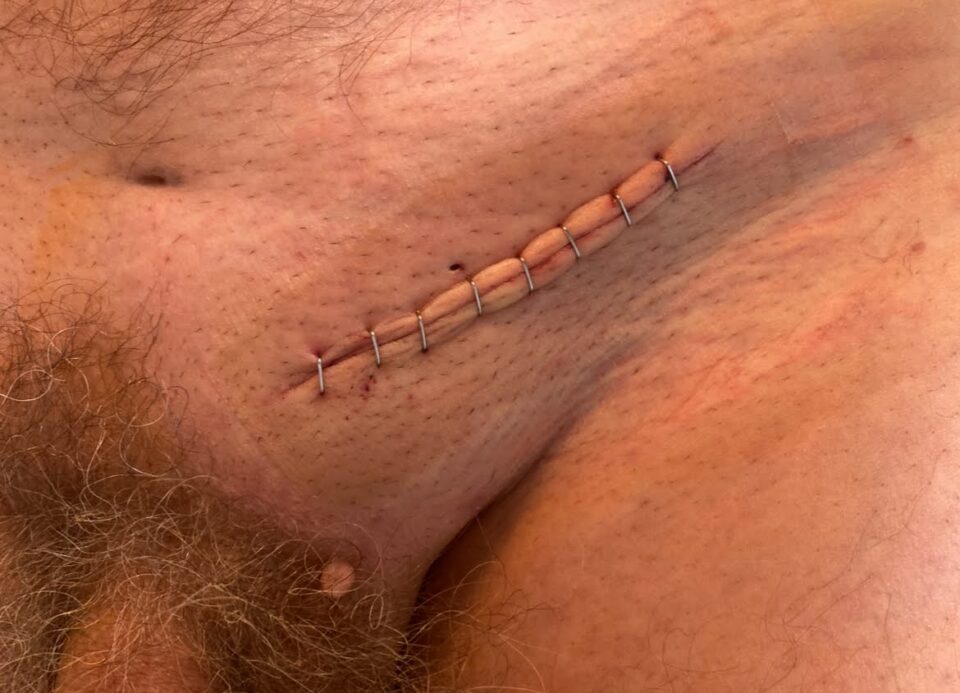 Desarda wygląd rany