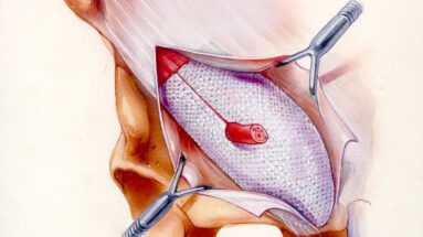 Trabucco przepuklina schemat