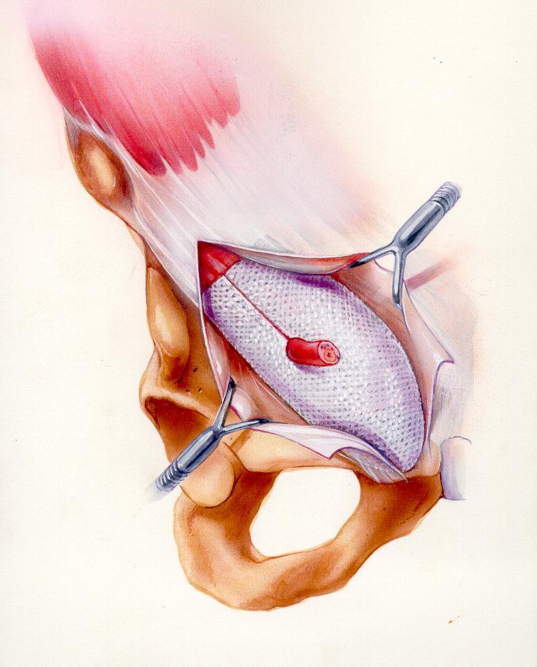 Włoski sposób: siatka ale nie przyszyta
