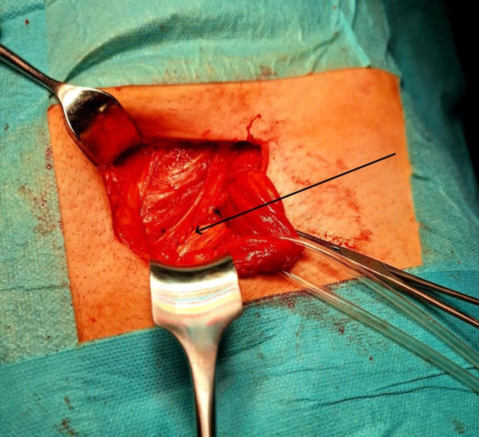 Pierwsza linia szwów