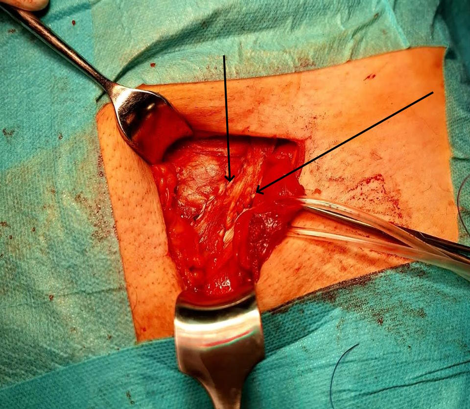 pasek rozcięgna przyszyty z obu stron