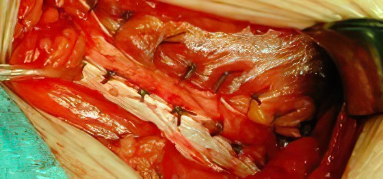 przepuklina pachwinowa bez siatki przepuklina pachwinowa bez siatki