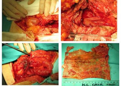 zakażona siatka usuwana w czasie operacji