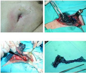 przetoka ropna do siatki