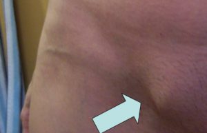 jednostronna_pachwinowa