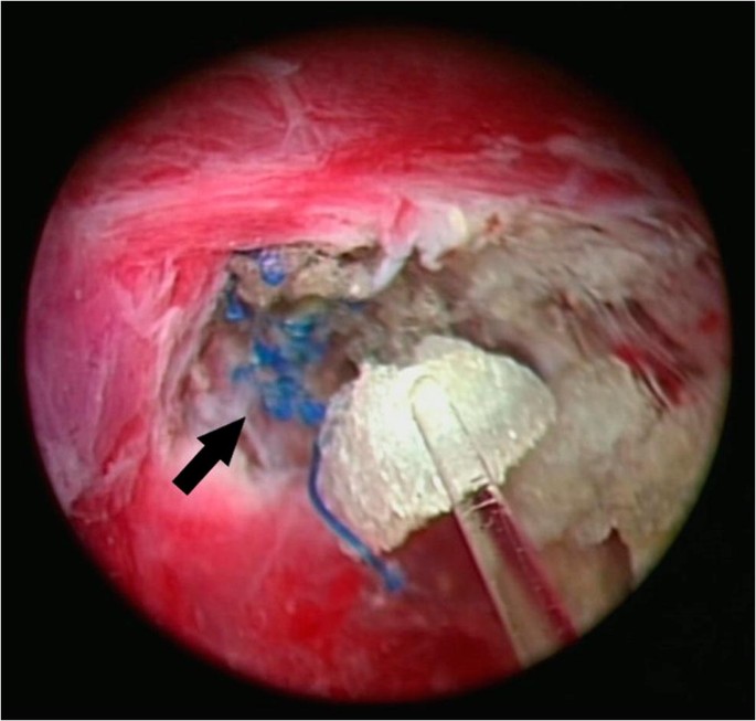 Siatka zawędrowała do pęcherza moczowego