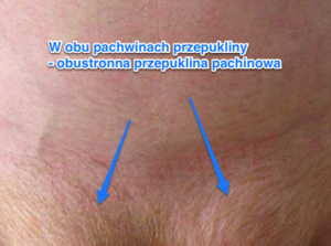 obustronna pachwinowa