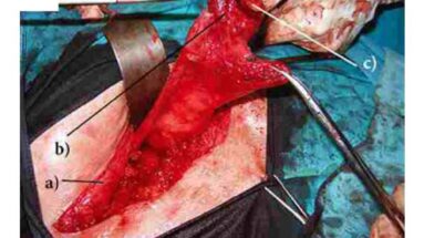 przetoka od siatki przepuklinowej do wyrostka