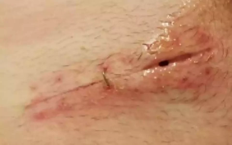 zakazona rana zakazona rana